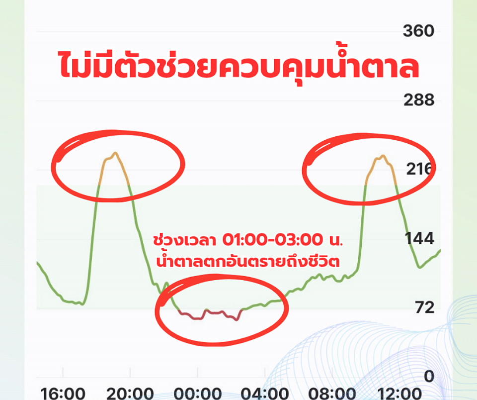 ระดับน้ำตาลในเลือดจากเครื่อง CGM